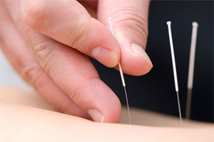 acupuncture